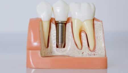 Diş implantı Nedir, Hangi Durumlarda Yapılır