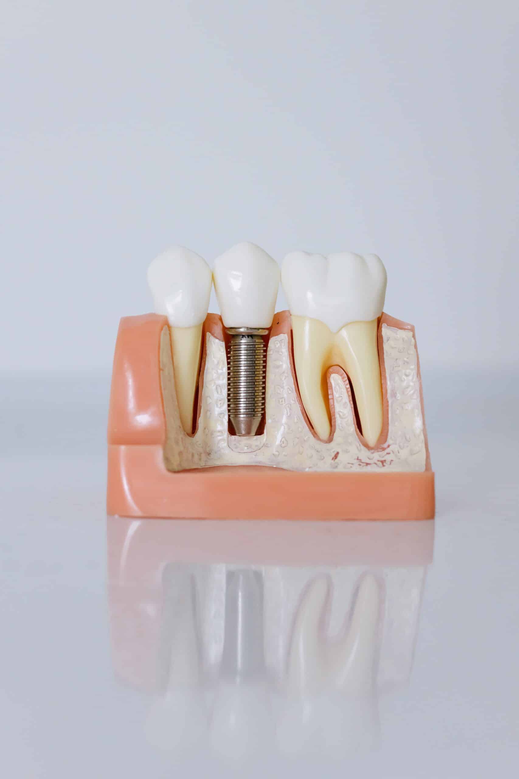Diş Implantı