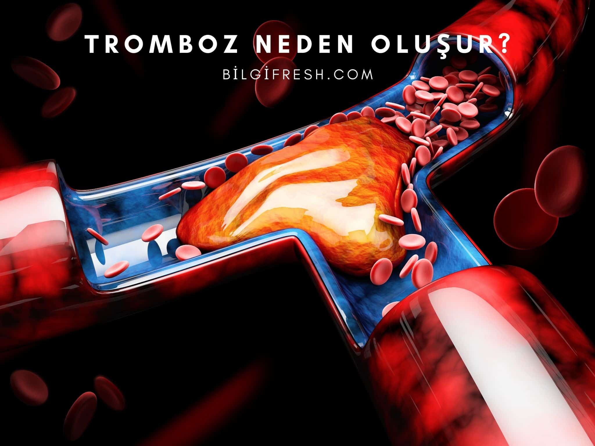 Tromboz Nedir